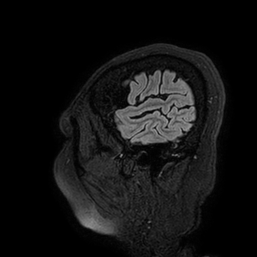 File:Cavernous hemangioma of the cerebellar falx (Radiopaedia 73025-83724 Sagittal FLAIR 12).jpg