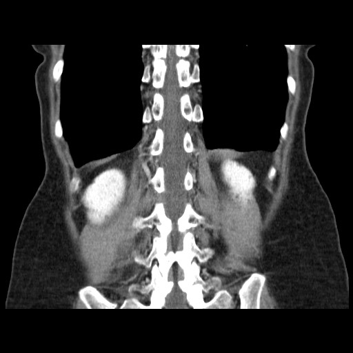 Cavernous hepatic hemangioma (Radiopaedia 75441-86667 C 116).jpg