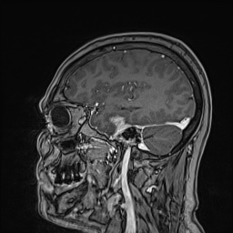Cavernous sinus meningioma (Radiopaedia 63682-72367 Sagittal T1 C+ 57).jpg