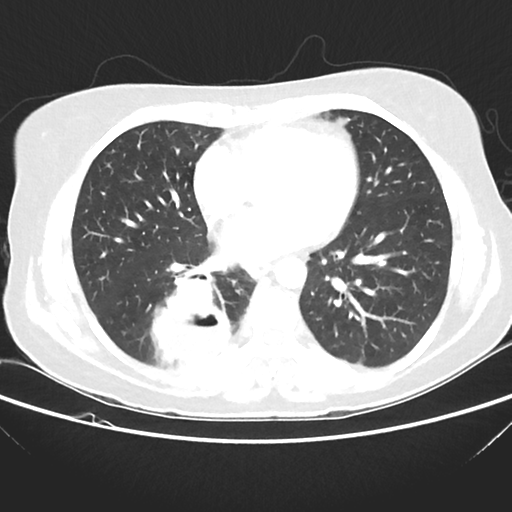 File:Cavitating lung mass - squamous cell carcinoma (Radiopaedia 48047-52854 Axial lung window 30).png