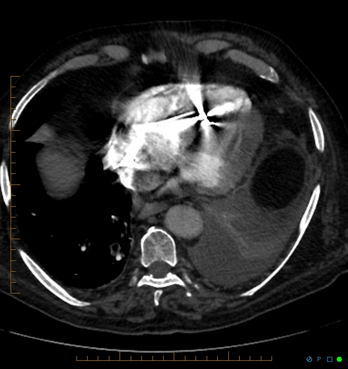 Cavitating pulmonary infarction (Radiopaedia 54634-60849 Axial C+ CTPA 62).jpg