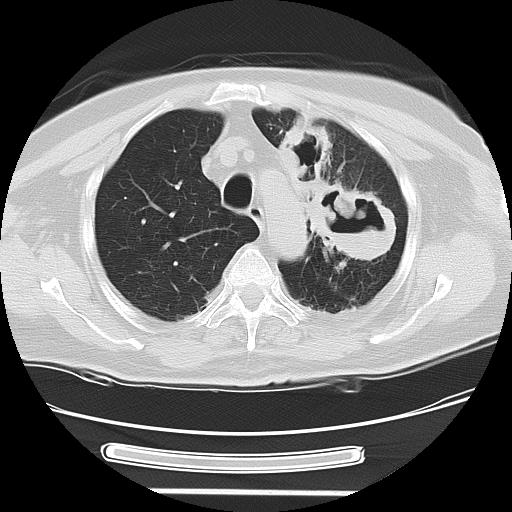 Cavitating pulmonary metastases (Radiopaedia 89545-106544 Axial lung window 15).jpg
