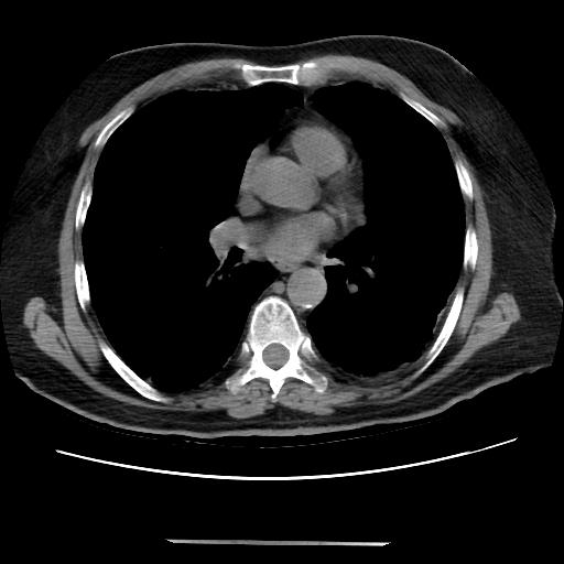Cavitating pulmonary metastases (Radiopaedia 89545-106544 Axial non-contrast 31).jpg