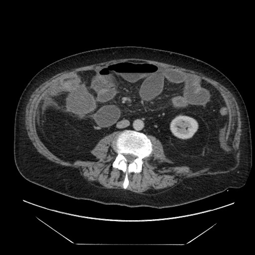 Cecal adenocarcinoma (Radiopaedia 64871-73817 A 53).jpg