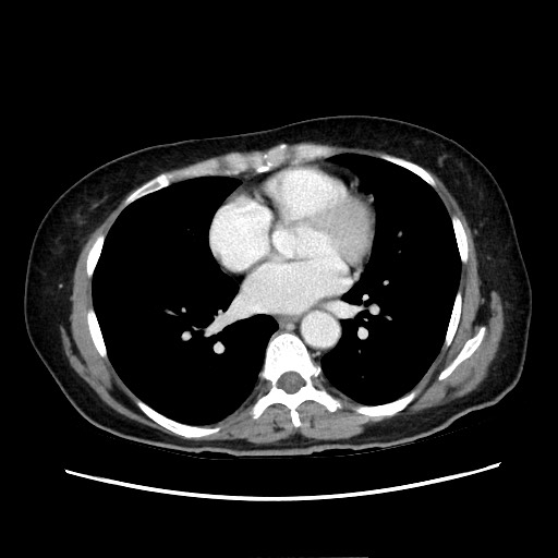 Cecal adenocarcinoma (Radiopaedia 75909-87331 A 6).jpg