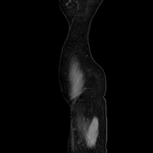 Cecal adenocarcinoma (Radiopaedia 75909-87331 C 9).jpg