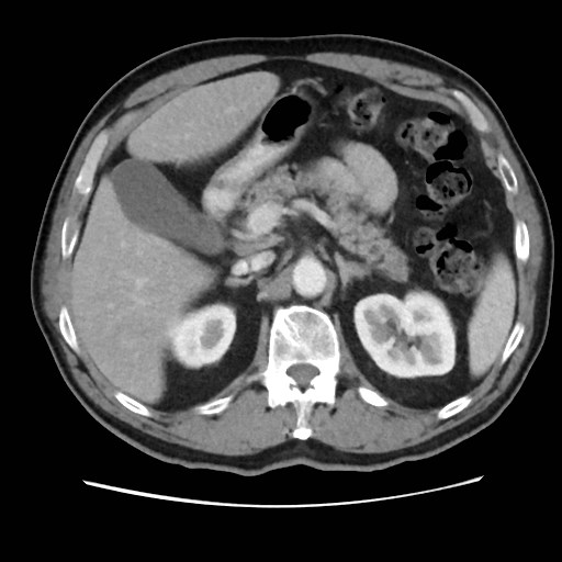 Cecal mass causing appendicitis (Radiopaedia 59207-66531 A 28).jpg