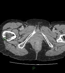 Cecal volvulus (Radiopaedia 86741-102900 A 144).jpg