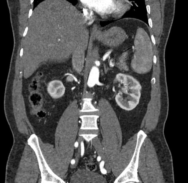 Celiac artery dissection (Radiopaedia 52194-58080 C 73).jpg