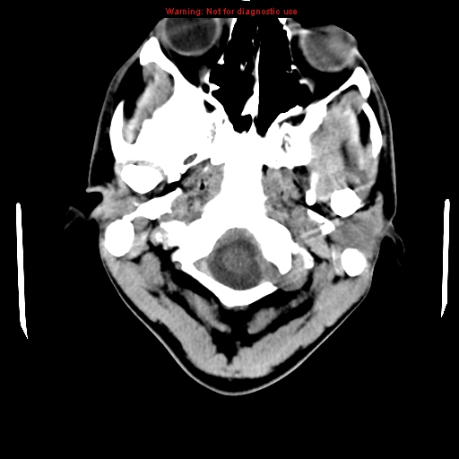 File:Central nervous system vasculitis (Radiopaedia 8410-9234 Axial non-contrast 2).jpg