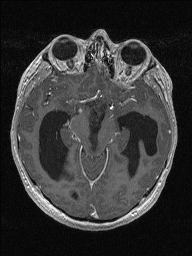 Central neurocytoma (Radiopaedia 56690-63469 Axial T1 C+ 63).jpg