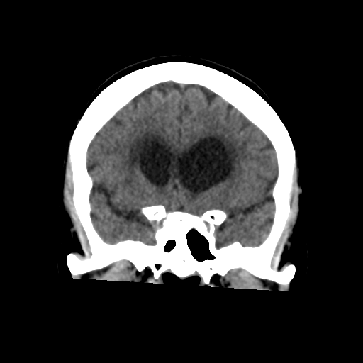 File:Central neurocytoma (Radiopaedia 65317-74346 Coronal non-contrast 22).png