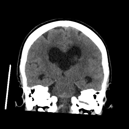 File:Central neurocytoma (Radiopaedia 65317-74346 Coronal non-contrast 34).png