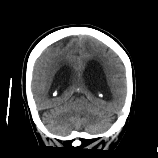 File:Central neurocytoma (Radiopaedia 65317-74346 Coronal non-contrast 42).png
