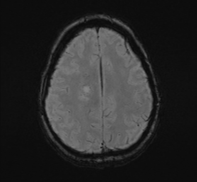 Central neurocytoma (Radiopaedia 70263-80336 Axial SWI 46).jpg