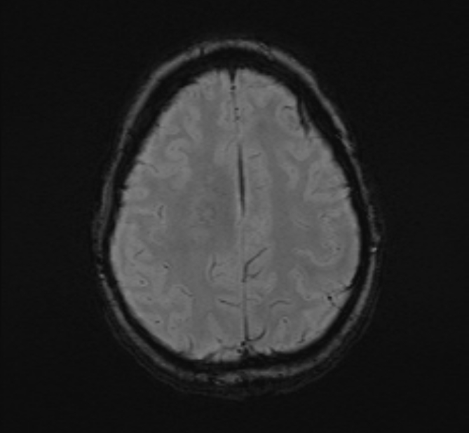 Central neurocytoma (Radiopaedia 70263-80336 Axial SWI 47).jpg