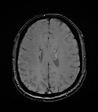 File:Central neurocytoma (Radiopaedia 71068-81303 Axial SWI 43).jpg