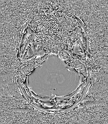 Central neurocytoma (Radiopaedia 84497-99872 Axial 17).jpg