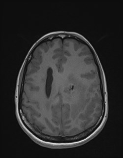 File:Central neurocytoma (Radiopaedia 84497-99872 Axial T1 137).jpg