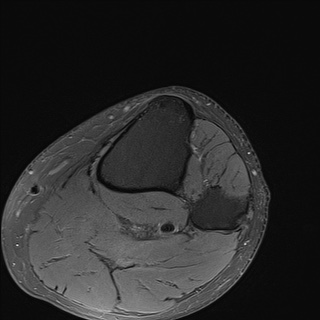 File:Central osteophyte (Radiopaedia 72592-83151 Axial PD fat sat 36).jpg