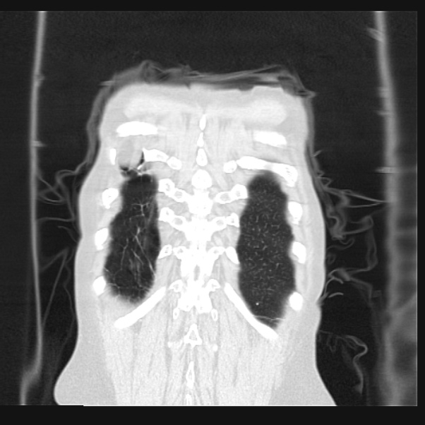 Centrilobular pulmonary emphysema (Radiopaedia 24495-24789 Coronal lung window 71).jpg