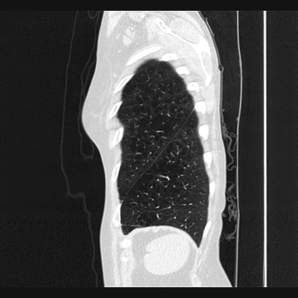 Centrilobular pulmonary emphysema (Radiopaedia 24495-24789 Sagittal lung window 77).jpg
