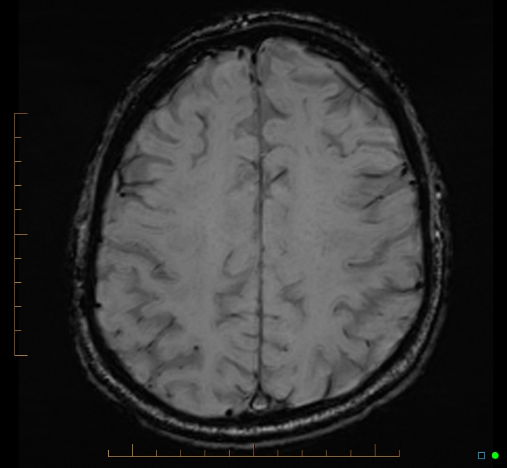 Cerebellar gangliocytoma (Radiopaedia 65377-74422 Axial SWI 43).jpg
