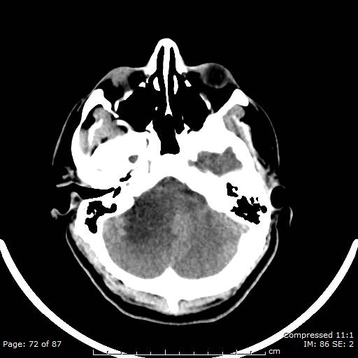 Cerebellar hemangioblastoma (Radiopaedia 52360-58258 Axial non-contrast 72).jpg