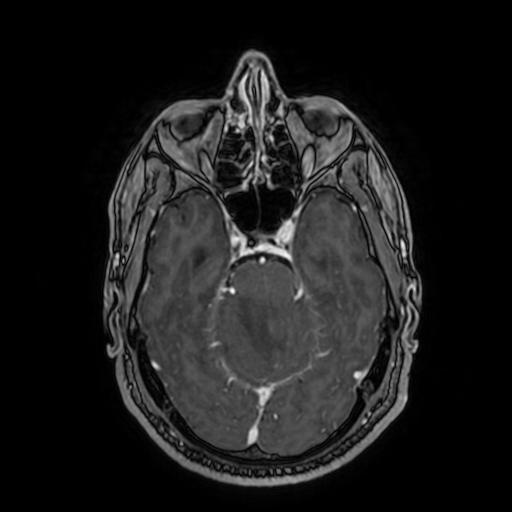 File:Cerebellar hemangioblastoma (Radiopaedia 88055-104622 Axial T1 C+ 69).jpg