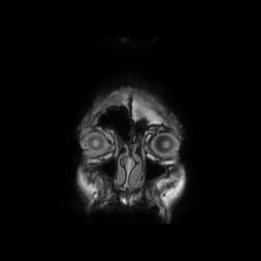 File:Cerebellar hemangioblastoma (Radiopaedia 88055-104622 Coronal T1 2).jpg