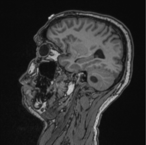 Cerebellar hemangioblastomas and pituitary adenoma (Radiopaedia 85490-101176 Sagittal T1 67).png