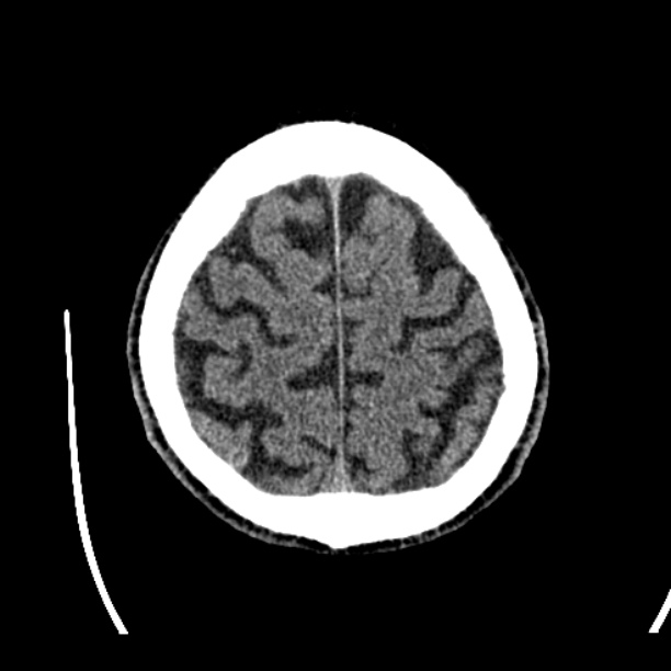 Cerebellar hemorrhage (Radiopaedia 27193-27359 Axial non-contrast 46).jpg