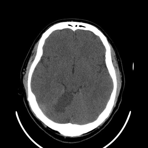 File:Cerebellar infarction (Radiopaedia 16625-16327 Axial non-contrast 17).jpg