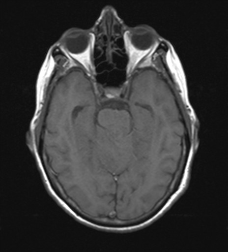 File:Cerebellar metastases (Radiopaedia 24038-24249 Axial T1 10).jpg