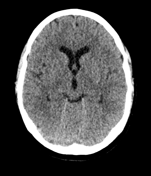 Cerebellar metastases - colorectal adenocarcinoma (Radiopaedia 40947-43652 Axial non-contrast 29).png