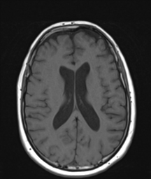 File:Cerebellar metastasis (Radiopaedia 54578-60810 Axial T1 23).png