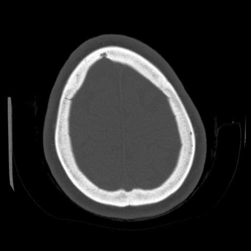 Cerebellar metastasis (cystic appearance) (Radiopaedia 41395-44258 Axial bone window 60).png