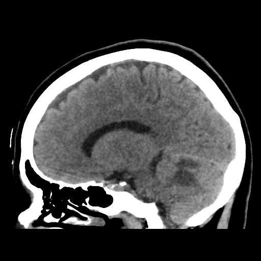 Cerebellar metastasis (cystic appearance) (Radiopaedia 41395-44258 E 33).png