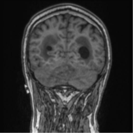 Cerebellar metastasis from lung adenocarcinoma (Radiopaedia 86690-102829 Coronal T1 28).png