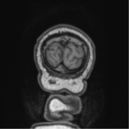 Cerebellar metastasis from lung adenocarcinoma (Radiopaedia 86690-102829 Coronal T1 6).png