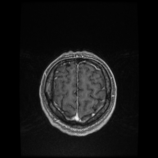 Cerebellar metastasis of pulmonary adenocarcinoma, cavernous venous malformation, and developmental venous anomaly (Radiopaedia 85827-101661 Axial T1 C+ 79).jpg