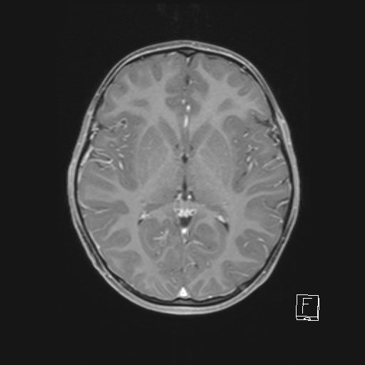 File:Cerebellar stroke (Radiopaedia 32202-33150 Axial T1 C+ 40).png