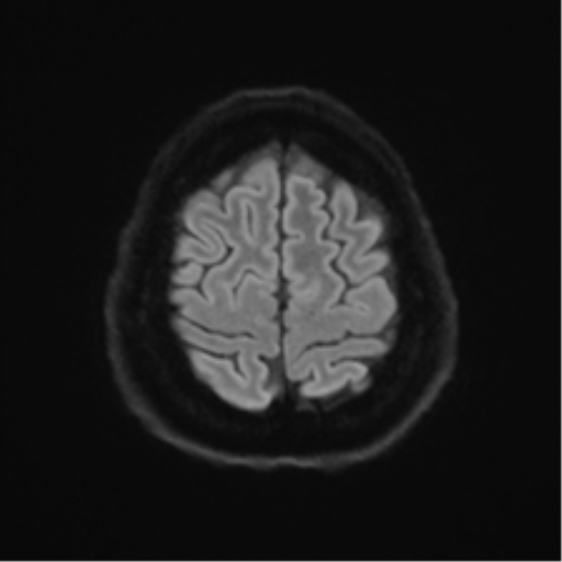 Cerebellopontine angle meningioma (Radiopaedia 48434-53348 Axial DWI 70).png