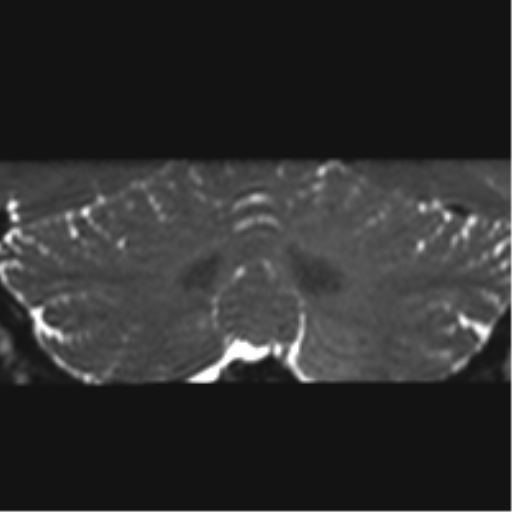 Cerebellopontine angle meningioma (Radiopaedia 48434-53348 Coronal T2 12).png