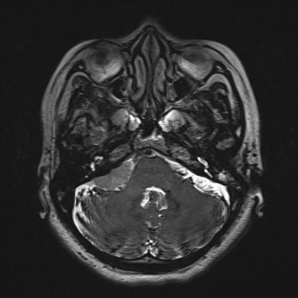 Cerebellopontine angle meningioma (Radiopaedia 53561-59591 Axial 3D volume T2 52).jpg