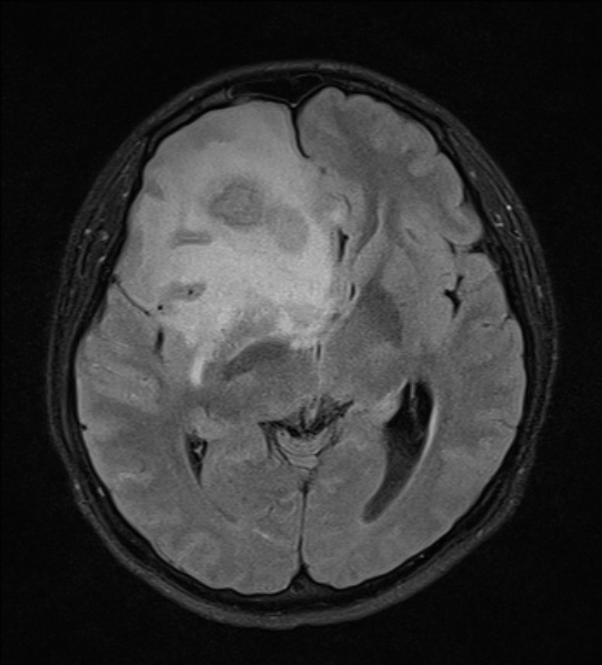 File:Cerebral abscess (Radiopaedia 24212-24478 Axial FLAIR 12).jpg