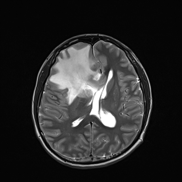 Cerebral abscess (Radiopaedia 24212-24478 Axial T2 36).jpg