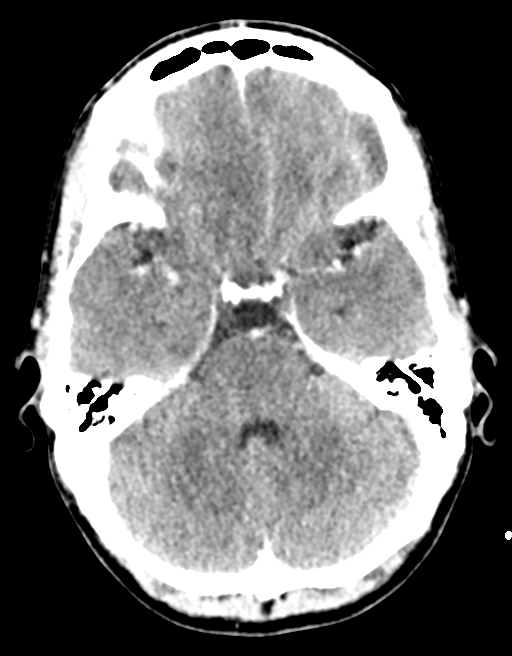 Cerebral abscess (Radiopaedia 60342-68008 Axial C+ delayed 16).png