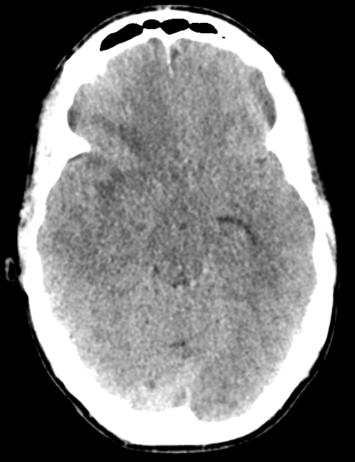 Cerebral abscess (Radiopaedia 60342-68008 Axial non-contrast 21).png