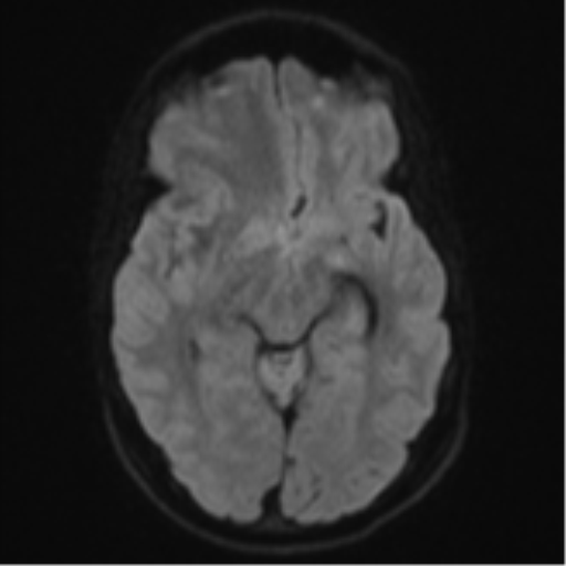 Cerebral abscess (Radiopaedia 60342-68009 Axial DWI 51).png